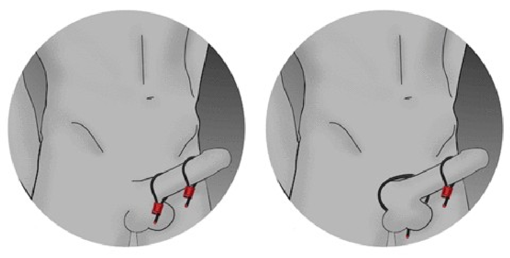 COCK-RING RUBBER/ALU ELECTRASTIM